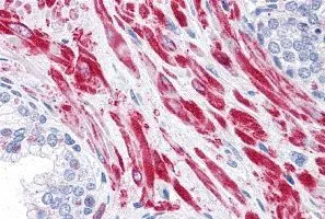 IHC-P analysis of human prostate tissue using GTX31767 AS160 / TBC1D4 antibody. Working concentration : 10 microg/ml IHC-P analysis of human prostate tissue using GTX31767 AS160 / TBC1D4 antibody. Working concentration : 10 microg/ml
