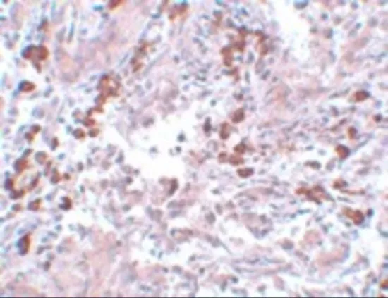 IHC-P analysis of human breast cancer tissue using GTX31800 NABC1 antibody. Working concentration : 5 microg/ml IHC-P analysis of human breast cancer tissue using GTX31800 NABC1 antibody. Working concentration : 5 microg/ml