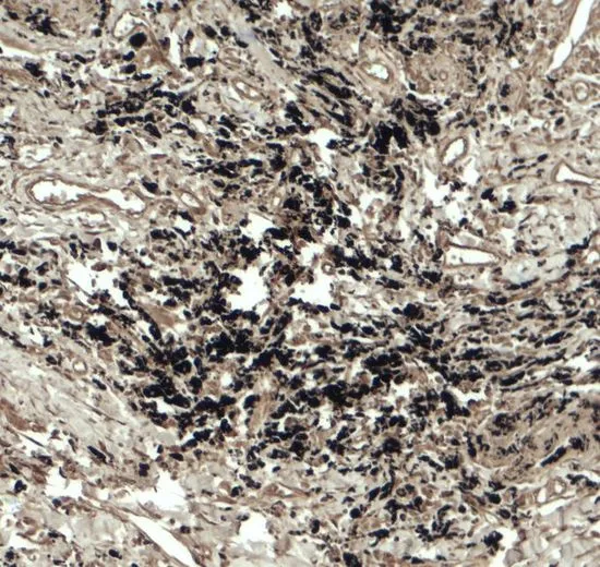 IHC-P analysis of human lung carcinoma tissue using GTX32141 Beclin 2 antibody. Working concentration : 5 microg/ml IHC-P analysis of human lung carcinoma tissue using GTX32141 Beclin 2 antibody. Working concentration : 5 microg/ml