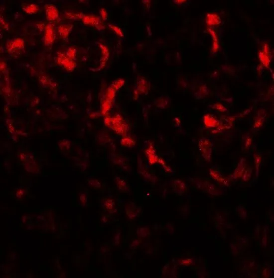 IHC-P analysis of human lung carcinoma tissue using GTX32141 Beclin 2 antibody. Working concentration : 20 microg/ml