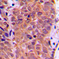 IHC-P analysis of formalin fixed human breast cancer tissue section using GTX32183 FOXO1 (phospho Ser319) antibody. Antigen retrieval : Heat mediated antigen retrieval with sodium citrate buffer (pH 6.0)