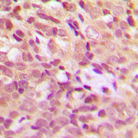 IHC-P analysis of formalin fixed human breast cancer tissue section using GTX32195 HSP27 (phospho Ser15) antibody. Antigen retrieval : Heat mediated antigen retrieval with sodium citrate buffer (pH 6.0) IHC-P analysis of formalin fixed human breast cancer tissue section using GTX32195 HSP27 (phospho Ser15) antibody. Antigen retrieval : Heat mediated antigen retrieval with sodium citrate buffer (pH 6.0)