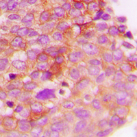 IHC-P analysis of formalin fixed human breast cancer tissue section using GTX32202 IRS1 (phospho Ser307) antibody. Antigen retrieval : Heat mediated antigen retrieval with sodium citrate buffer (pH 6.0) IHC-P analysis of formalin fixed human breast cancer tissue section using GTX32202 IRS1 (phospho Ser307) antibody. Antigen retrieval : Heat mediated antigen retrieval with sodium citrate buffer (pH 6.0)