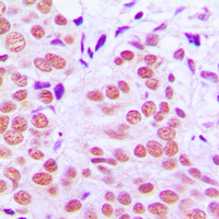 IHC-P analysis of formalin fixed human breast cancer tissue section using GTX32204 c-Jun (phospho Thr91) antibody. Antigen retrieval : Heat mediated antigen retrieval with sodium citrate buffer (pH 6.0) IHC-P analysis of formalin fixed human breast cancer tissue section using GTX32204 c-Jun (phospho Thr91) antibody. Antigen retrieval : Heat mediated antigen retrieval with sodium citrate buffer (pH 6.0)
