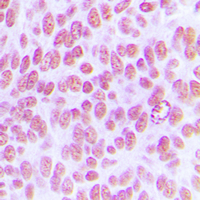 IHC-P analysis of formalin fixed human breast cancer tissue section using GTX32205 c-Jun (phospho Tyr170) antibody. Antigen retrieval : Heat mediated antigen retrieval with sodium citrate buffer (pH 6.0) IHC-P analysis of formalin fixed human breast cancer tissue section using GTX32205 c-Jun (phospho Tyr170) antibody. Antigen retrieval : Heat mediated antigen retrieval with sodium citrate buffer (pH 6.0)