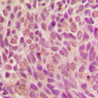 IHC-P analysis of formalin fixed human breast cancer tissue section using GTX32213 Smad1 (phospho Ser187) antibody. Antigen retrieval : Heat mediated antigen retrieval with sodium citrate buffer (pH 6.0) IHC-P analysis of formalin fixed human breast cancer tissue section using GTX32213 Smad1 (phospho Ser187) antibody. Antigen retrieval : Heat mediated antigen retrieval with sodium citrate buffer (pH 6.0)