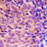 IHC-P analysis of formalin fixed human breast cancer tissue section using GTX32223 NFkB p105/p50 (phospho Ser337) antibody. Antigen retrieval : Heat mediated antigen retrieval with sodium citrate buffer (pH 6.0) IHC-P analysis of formalin fixed human breast cancer tissue section using GTX32223 NFkB p105/p50 (phospho Ser337) antibody. Antigen retrieval : Heat mediated antigen retrieval with sodium citrate buffer (pH 6.0)