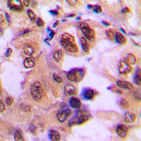IHC-P analysis of formalin fixed human breast cancer tissue section using GTX32224 IKB alpha (phospho Ser32/Ser36) antibody. Antigen retrieval : Heat mediated antigen retrieval with sodium citrate buffer (pH 6.0)