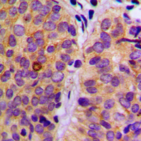 IHC-P analysis of formalin fixed human breast cancer tissue section using GTX32240 PLCG2 (phospho Tyr753) antibody. Antigen retrieval : Heat mediated antigen retrieval with sodium citrate buffer (pH 6.0) IHC-P analysis of formalin fixed human breast cancer tissue section using GTX32240 PLCG2 (phospho Tyr753) antibody. Antigen retrieval : Heat mediated antigen retrieval with sodium citrate buffer (pH 6.0)