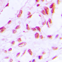 IHC-P analysis of formalin fixed human breast cancer tissue section using GTX32254 Rb (phospho Ser780) antibody. Antigen retrieval : Heat mediated antigen retrieval with sodium citrate buffer (pH 6.0)