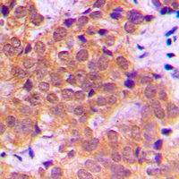 IHC-P analysis of formalin fixed human breast cancer tissue section using GTX32256 NFkB p65 (phospho Ser468) antibody. Antigen retrieval : Heat mediated antigen retrieval with sodium citrate buffer (pH 6.0) IHC-P analysis of formalin fixed human breast cancer tissue section using GTX32256 NFkB p65 (phospho Ser468) antibody. Antigen retrieval : Heat mediated antigen retrieval with sodium citrate buffer (pH 6.0)