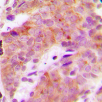 IHC-P analysis of formalin fixed human breast cancer tissue section using GTX32259 p70 S6K (phospho Thr421) antibody. Antigen retrieval : Heat mediated antigen retrieval with sodium citrate buffer (pH 6.0) IHC-P analysis of formalin fixed human breast cancer tissue section using GTX32259 p70 S6K (phospho Thr421) antibody. Antigen retrieval : Heat mediated antigen retrieval with sodium citrate buffer (pH 6.0)