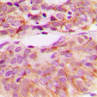 IHC-P analysis of formalin fixed human breast cancer tissue section using GTX32265 Src (phospho Tyr527) antibody. Antigen retrieval : Heat mediated antigen retrieval with sodium citrate buffer (pH 6.0) IHC-P analysis of formalin fixed human breast cancer tissue section using GTX32265 Src (phospho Tyr527) antibody. Antigen retrieval : Heat mediated antigen retrieval with sodium citrate buffer (pH 6.0)