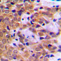 IHC-P analysis of formalin fixed human breast cancer tissue section using GTX32268 STAT5A (phospho Ser780) antibody. Antigen retrieval : Heat mediated antigen retrieval with sodium citrate buffer (pH 6.0)