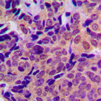 IHC-P analysis of formalin fixed human breast cancer tissue section using GTX32308 APP (phospho Thr743) antibody. Antigen retrieval : Heat mediated antigen retrieval with sodium citrate buffer (pH 6.0) IHC-P analysis of formalin fixed human breast cancer tissue section using GTX32308 APP (phospho Thr743) antibody. Antigen retrieval : Heat mediated antigen retrieval with sodium citrate buffer (pH 6.0)