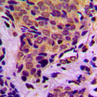 IHC-P analysis of formalin fixed human breast cancer tissue section using GTX32322 4E-BP1 (phospho Thr37) antibody. Antigen retrieval : Heat mediated antigen retrieval with sodium citrate buffer (pH 6.0) IHC-P analysis of formalin fixed human breast cancer tissue section using GTX32322 4E-BP1 (phospho Thr37) antibody. Antigen retrieval : Heat mediated antigen retrieval with sodium citrate buffer (pH 6.0)