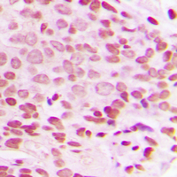IHC-P analysis of formalin fixed human breast cancer tissue section using GTX32331 c-Jun (phospho Thr93) antibody. Antigen retrieval : Heat mediated antigen retrieval with sodium citrate buffer (pH 6.0) IHC-P analysis of formalin fixed human breast cancer tissue section using GTX32331 c-Jun (phospho Thr93) antibody. Antigen retrieval : Heat mediated antigen retrieval with sodium citrate buffer (pH 6.0)