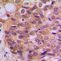 IHC-P analysis of formalin fixed human breast cancer tissue section using GTX32335 SMAD3 (phospho Ser425) antibody. Antigen retrieval : Heat mediated antigen retrieval with sodium citrate buffer (pH 6.0) IHC-P analysis of formalin fixed human breast cancer tissue section using GTX32335 SMAD3 (phospho Ser425) antibody. Antigen retrieval : Heat mediated antigen retrieval with sodium citrate buffer (pH 6.0)