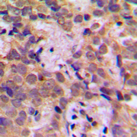 IHC-P analysis of formalin fixed human breast cancer tissue section using GTX32341 NFkB p105 (phospho Ser932) antibody. Antigen retrieval : Heat mediated antigen retrieval with sodium citrate buffer (pH 6.0) IHC-P analysis of formalin fixed human breast cancer tissue section using GTX32341 NFkB p105 (phospho Ser932) antibody. Antigen retrieval : Heat mediated antigen retrieval with sodium citrate buffer (pH 6.0)
