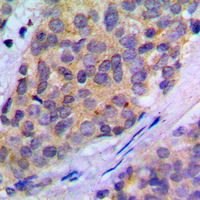 IHC-P analysis of formalin fixed human breast cancer tissue section using GTX32342 PLA2G4A (phospho Ser505) antibody. Antigen retrieval : Heat mediated antigen retrieval with sodium citrate buffer (pH 6.0)
