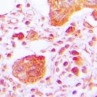 IHC-P analysis of formalin fixed human lung cancer tissue section using GTX32343 PLCG1 (phospho Tyr783) antibody. Antigen retrieval : Heat mediated antigen retrieval with sodium citrate buffer (pH 6.0) IHC-P analysis of formalin fixed human lung cancer tissue section using GTX32343 PLCG1 (phospho Tyr783) antibody. Antigen retrieval : Heat mediated antigen retrieval with sodium citrate buffer (pH 6.0)