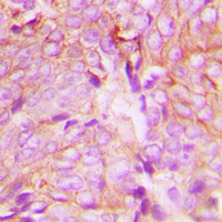 IHC-P analysis of formalin fixed human breast cancer tissue section using GTX32346 PKC delta (phospho Tyr313) antibody. Antigen retrieval : Heat mediated antigen retrieval with sodium citrate buffer (pH 6.0) IHC-P analysis of formalin fixed human breast cancer tissue section using GTX32346 PKC delta (phospho Tyr313) antibody. Antigen retrieval : Heat mediated antigen retrieval with sodium citrate buffer (pH 6.0)