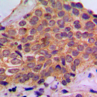 IHC-P analysis of formalin fixed human breast cancer tissue section using GTX32352 p70 S6K (phospho Ser434) antibody. Antigen retrieval : Heat mediated antigen retrieval with sodium citrate buffer (pH 6.0)