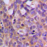 IHC-P analysis of formalin fixed human breast cancer tissue section using GTX32353 p70 S6K (phospho Thr444) antibody. Antigen retrieval : Heat mediated antigen retrieval with sodium citrate buffer (pH 6.0)