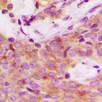IHC-P analysis of formalin fixed human breast cancer tissue section using GTX32354 p70 S6K (phospho Ser447) antibody. Antigen retrieval : Heat mediated antigen retrieval with sodium citrate buffer (pH 6.0)