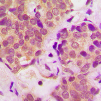 IHC-P analysis of formalin fixed human breast cancer tissue section using GTX32357 STAT6 (phospho Tyr641) antibody. Antigen retrieval : Heat mediated antigen retrieval with sodium citrate buffer (pH 6.0) IHC-P analysis of formalin fixed human breast cancer tissue section using GTX32357 STAT6 (phospho Tyr641) antibody. Antigen retrieval : Heat mediated antigen retrieval with sodium citrate buffer (pH 6.0)