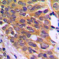IHC-P analysis of formalin fixed human prostate cancer tissue section using GTX32365 eEF-2K (phospho Ser366) antibody. Antigen retrieval : Heat mediated antigen retrieval with sodium citrate buffer (pH 6.0) IHC-P analysis of formalin fixed human prostate cancer tissue section using GTX32365 eEF-2K (phospho Ser366) antibody. Antigen retrieval : Heat mediated antigen retrieval with sodium citrate buffer (pH 6.0)