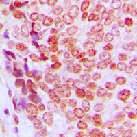 IHC-P analysis of formalin fixed human prostate cancer tissue section using GTX32376 p21 Cip1 (phospho Thr145) antibody. Antigen retrieval : Heat mediated antigen retrieval with sodium citrate buffer (pH 6.0)