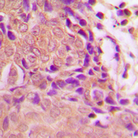 IHC-P analysis of formalin fixed human cervix cancer tissue section using GTX32378 CDKN2A / p16INK4a (phospho Ser326) antibody. Antigen retrieval : Heat mediated antigen retrieval with sodium citrate buffer (pH 6.0) IHC-P analysis of formalin fixed human cervix cancer tissue section using GTX32378 CDKN2A / p16INK4a (phospho Ser326) antibody. Antigen retrieval : Heat mediated antigen retrieval with sodium citrate buffer (pH 6.0)