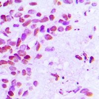 IHC-P analysis of formalin fixed human breast cancer tissue section using GTX32390 Estrogen Receptor alpha (phospho Ser106) antibody. Antigen retrieval : Heat mediated antigen retrieval with sodium citrate buffer (pH 6.0)