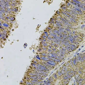 IHC-P analysis of human colon carcinoma tissue using GTX32431 ALDH1A1 antibody. Dilution : 1:100