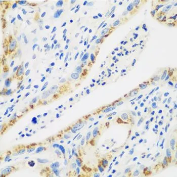 IHC-P analysis of human stomach cancer tissue using GTX32491 Cathepsin G antibody. Dilution : 1:100
