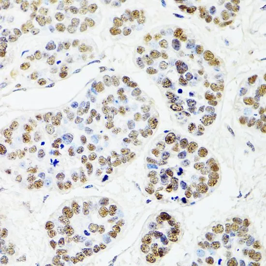 IHC-P analysis of human esophageal cancer tissue using GTX32513 CDX2 antibody. Dilution : 1:100