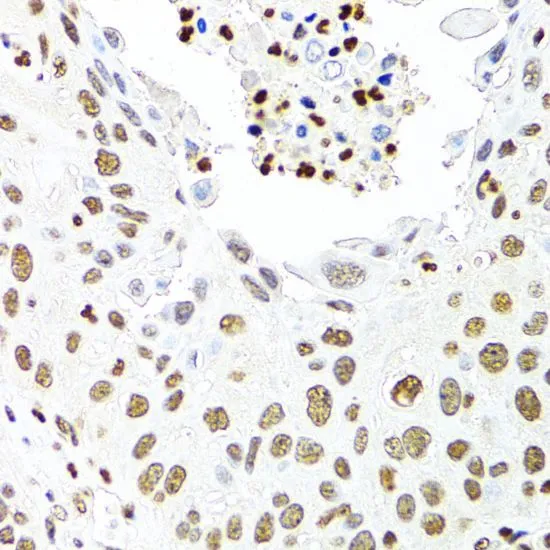 IHC-P analysis of human lung cancer tissue using GTX32513 CDX2 antibody. Dilution : 1:100