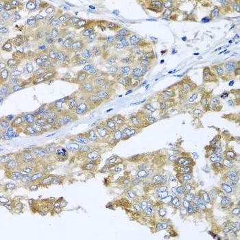 IHC-P analysis of human liver cancer tissue using GTX32534 COQ7 antibody. Dilution : 1:100