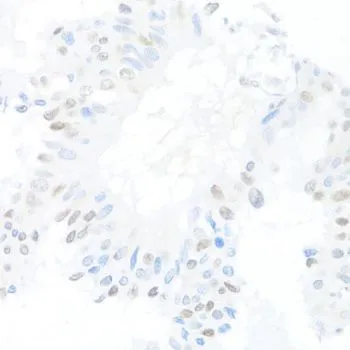 IHC-P analysis of human mammary cancer tissue using GTX32538 CREM antibody. Dilution : 1:100