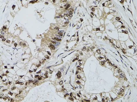 IHC-P analysis of human gastric cancer tissue using GTX32553 DCK antibody. Dilution : 1:100