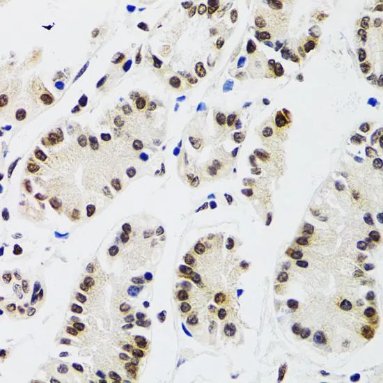 IHC-P analysis of human gastric cancer tissue using GTX32571 EDF1 antibody. Dilution : 1:100