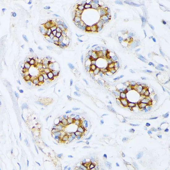 IHC-P analysis of human breast cancer tissue using GTX32598 Fatty Acid Synthase antibody. Dilution : 1:200