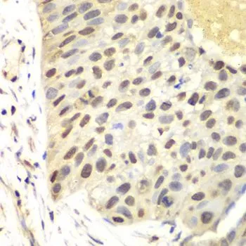 IHC-P analysis of human lung cancer tissue using GTX32600 FEN1 antibody. Dilution : 1:100