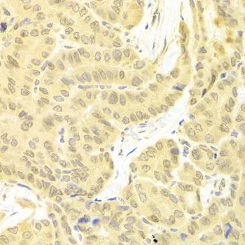 IHC-P analysis of human thyroid cancer tissue using GTX32608 FLIP antibody. Dilution : 1:100