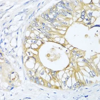 IHC-P analysis of human colon carcinoma tissue using GTX32614 GNAI3 antibody. Dilution : 1:100