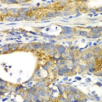 IHC-P analysis of human gastric cancer tissue using GTX32631 GRASP65 antibody. Dilution : 1:100