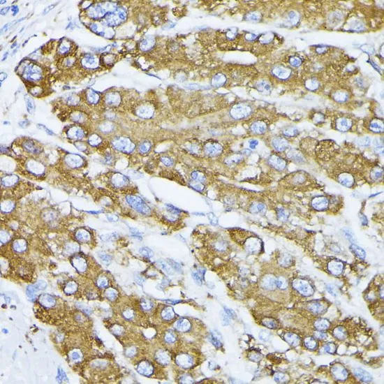 IHC-P analysis of human liver cancer tissue using GTX32636 Grp78 antibody. Dilution : 1:100