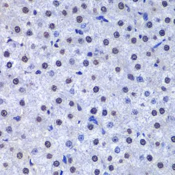 IHC-P analysis of human liver cancer tissue using GTX32639 GSTP1 antibody. Dilution : 1:200
