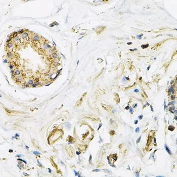 IHC-P analysis of human breast cancer tissue using GTX32699 LAMP2 antibody. Dilution : 1:100